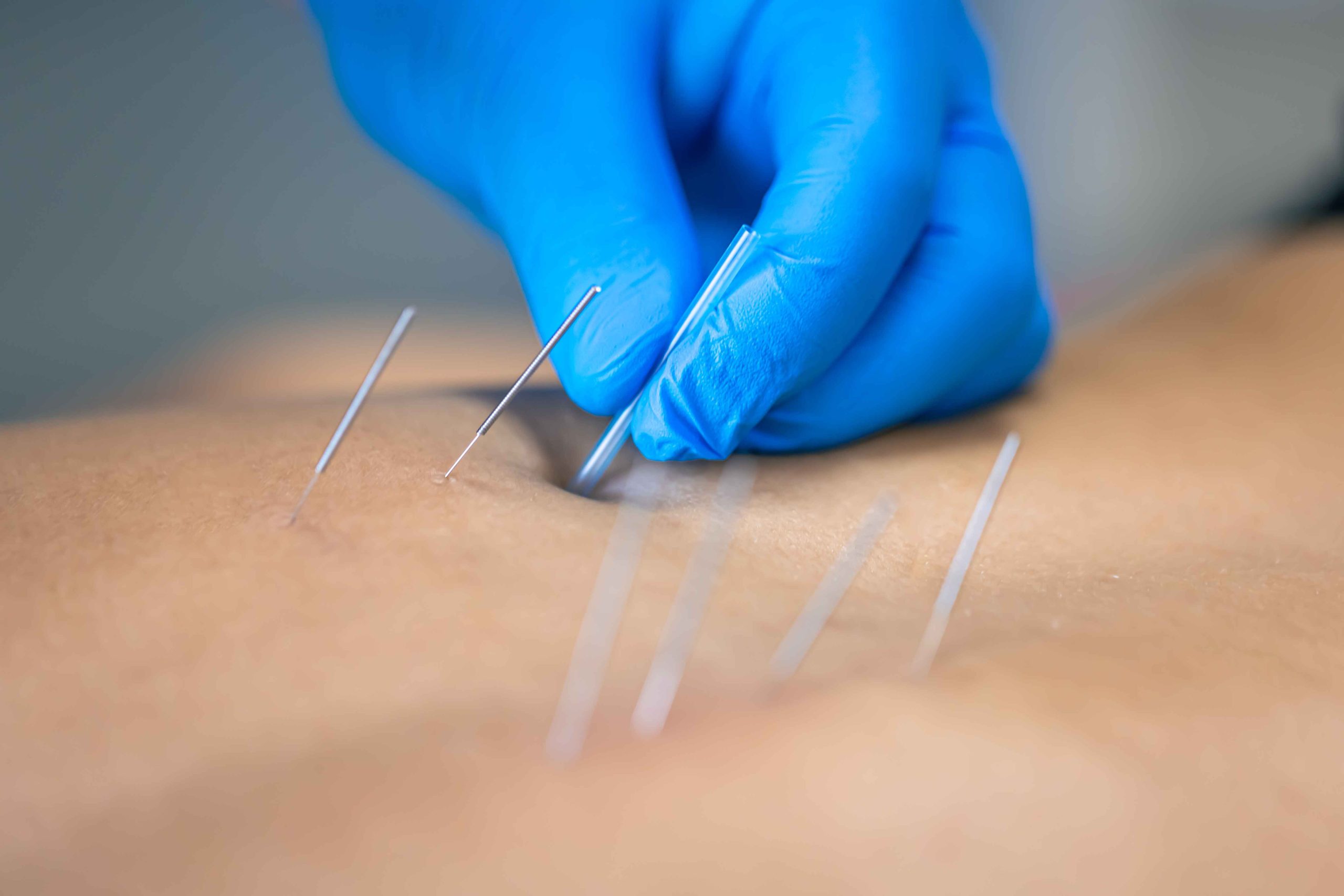 Acupuncture Woolloongabba